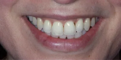 Antes: espaços escuros entre os dentes da frente, junto à gengiva