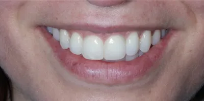 Depois: os espaços fechados e os dentes da frente mais uniformes