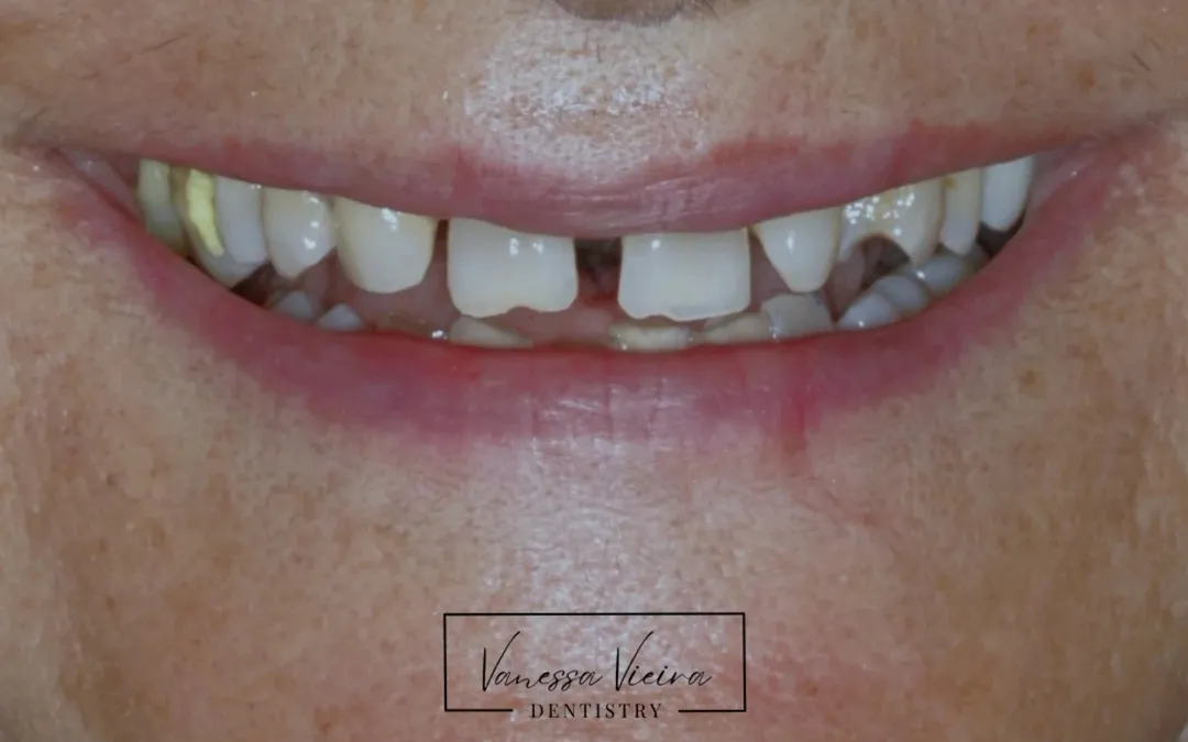 Antes: dentes de cima pequenos, com espaços abertos entre eles