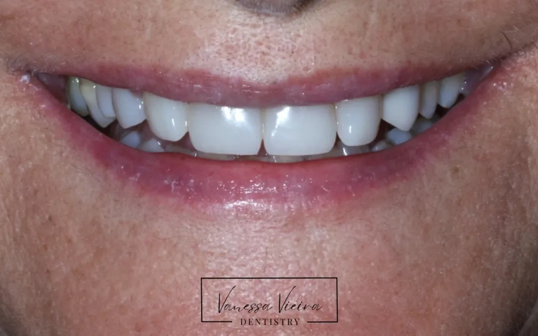 Depois: os mesmos dentes, sem espaços, refeitos em resina composta