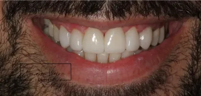 Depois: dentes da frente mais compridos, refeitos em resina
