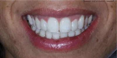 Depois: os mesmos dentes aumentados, em proporção com os da frente