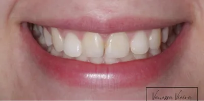 Antes: os dois dentes da frente, amarelados e de bordos desiguais