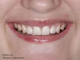 Sorriso com os dois dentes da frente em resina, 1 ano e 5 meses depois