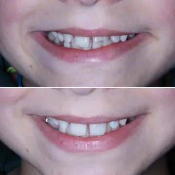 Em cima, o dente da frente de uma criança partido. Em baixo, o mesmo dente reconstruído